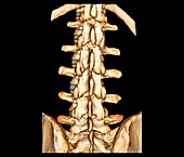 Normal spine,3D CT scan