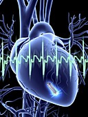 Heart with leadless cardiac pacemaker