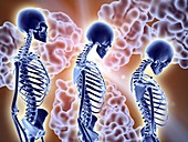 Osteoporosis treatment with antibodies