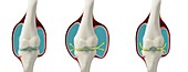 Arthritis pain in weather change