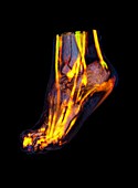 Human foot,CT scan