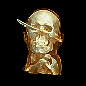 Knife skull injury,CT scan