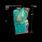 Scoliosis,CT scan