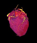 Human heart,CT scan