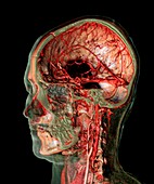 Skull and brain blood vessels,CT scan