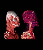 Human skull and blood vessels,CT scans