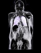 Trapped abdominal gas,CT scan