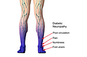 Diabetic Neuropathy,illustration