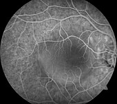 Retinal pigment epithelial detachment