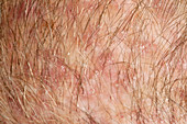 Folliculitis of the scalp