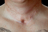 Scar revision after surgery