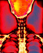 Neck vertebrae and skull,coloured X-ray