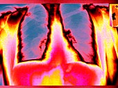Lungs and ribs,coloured chest X-ray