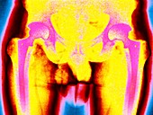 Double hip replacement,coloured X-ray