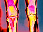 Knee replacement,coloured X-ray