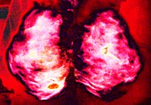 Mammogram,coloured X-ray