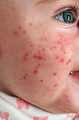 Chicken pox