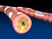 Acute bronchitis,illustration