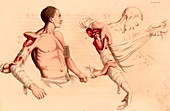 Amputation of the arm at the shoulder