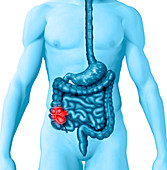 Crohn's Disease,illustration