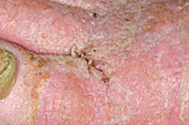 Maggots in eczema