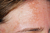 Melasma of the face