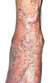 Varicose veins on foot