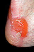 Foot blister in chemotherapy