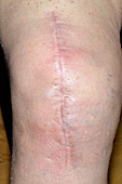 Infected total knee replacement wound