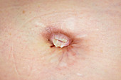 Stoma in congenital bladder exstrophy