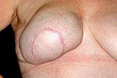 Breast reconstruction after cancer