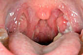 Viral tonsillitis