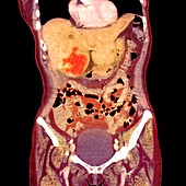 Liver cancer,X-ray