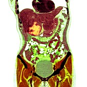 Liver cancer,X-ray