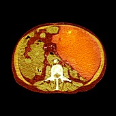 Bowel cancer,X-ray