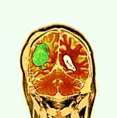 Brain cancer after surgery,MRI