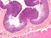 Large bowel polyps,light micrograph