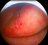 Endometrial polyp,endoscope view