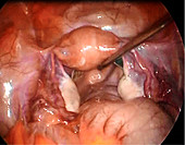 Female pelvis,endoscope view