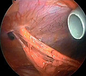 Omental adhesions,endoscope view