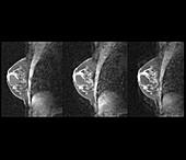 Breast cyst,MRI