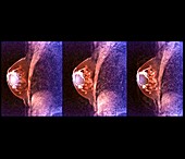 Breast cyst,MRI