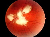 Myelin fibres in the eye,fundus image