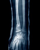 Wrist fracture,X-ray