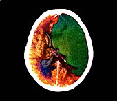 Brain in stroke,CT scan