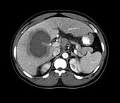 Liver abscess,CT scan