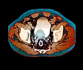 Prostate tumour,CT scan