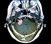 Brain tumour,MRI