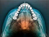 Normal teeth,3D CBCT scan