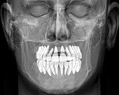 Normal teeth,3D CBCT scan